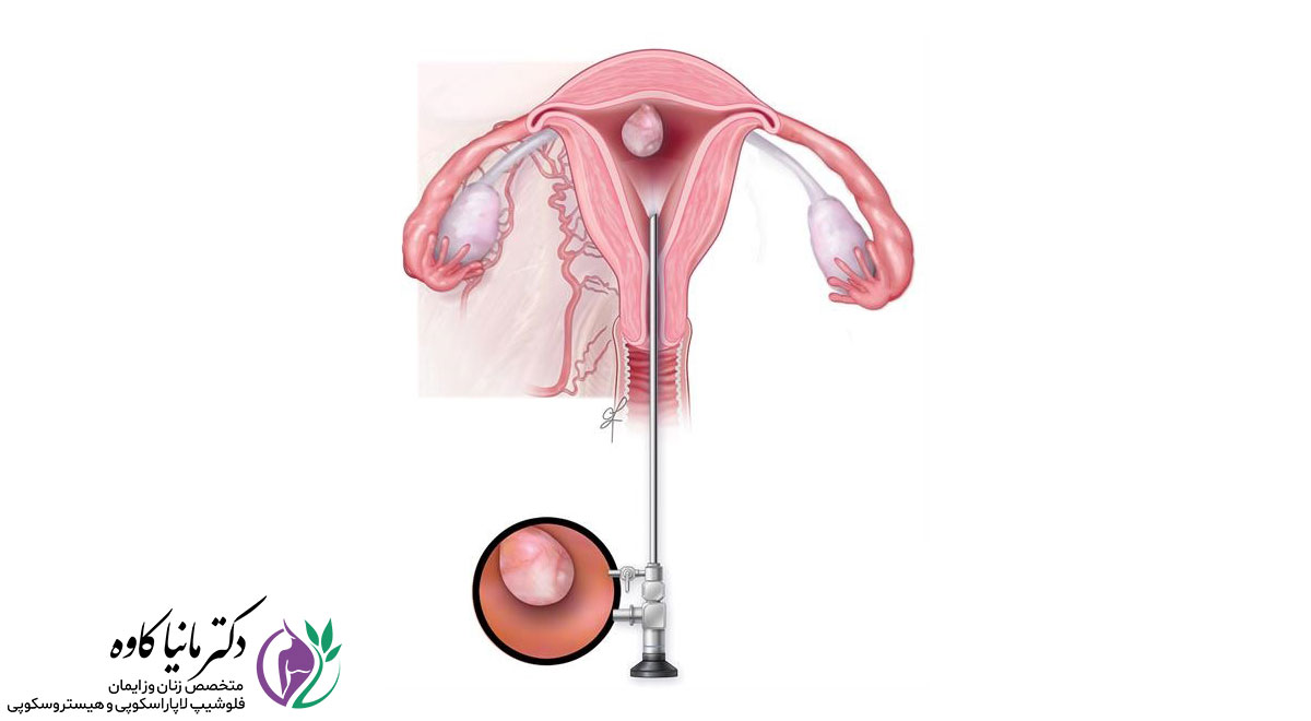 غربالگری هیستروسکوپی (hysteroscopy) در زنان نابارور