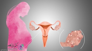 درمان تخمدان پلی کیستیک برای بارداری